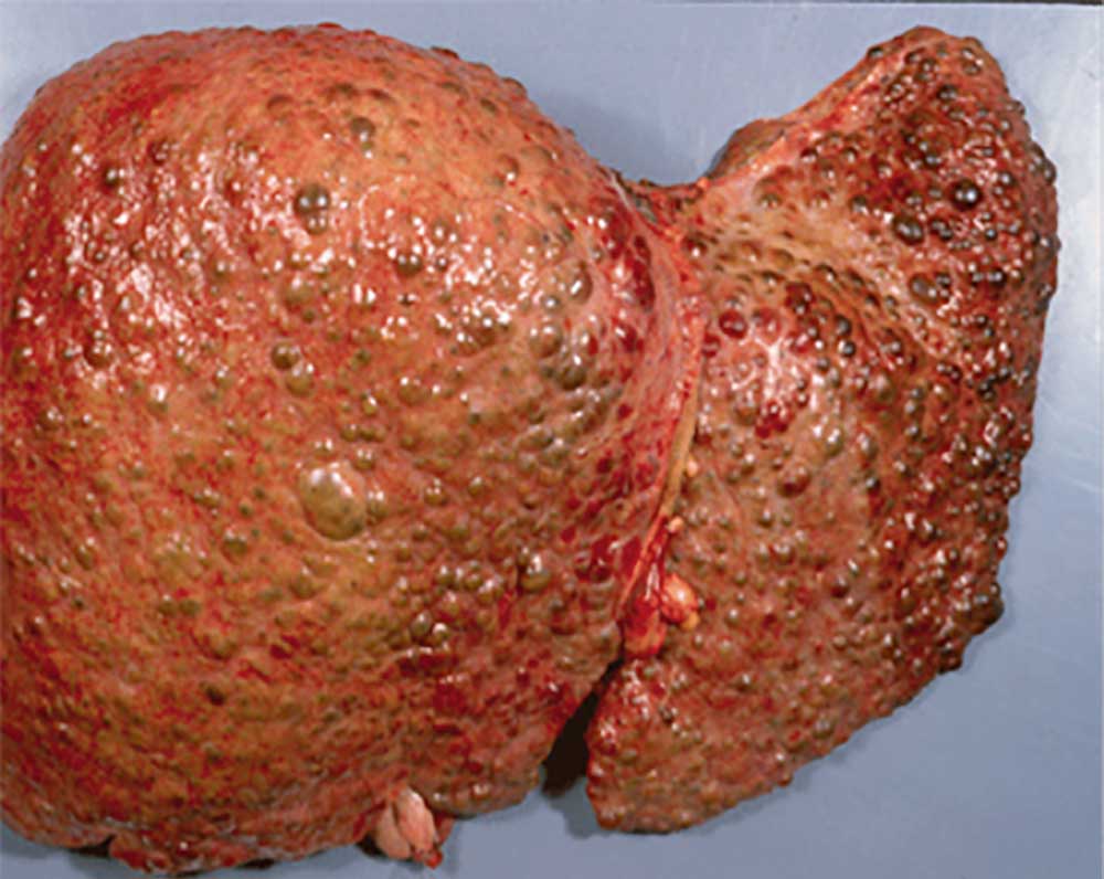 liver with signs of cirrhosis