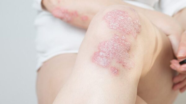 Psoriasis on knee and elbow