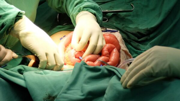 Partial Colectomy